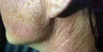 皮肌炎症状,皮肤与肌肉的双重警示